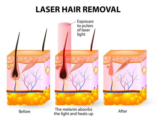 Spa Salon 20HZ 808 Diode Lazer Epilasyon Makinesi